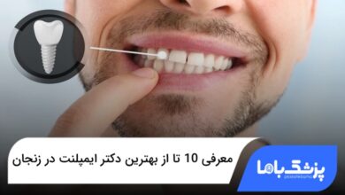 بهترین دکتر ایمپلنت در زنجان