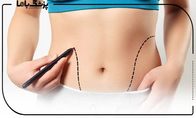 بهترین دکتر لیپوماتیک در تبریز را چگونه انتخاب کنیم؟