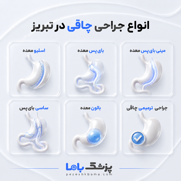 جراحی چاقی با اسلیو بهتر است یا بای پس؟