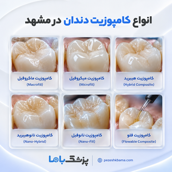 تفاوت کامپوزیت دندان با لمینت سرامیکی