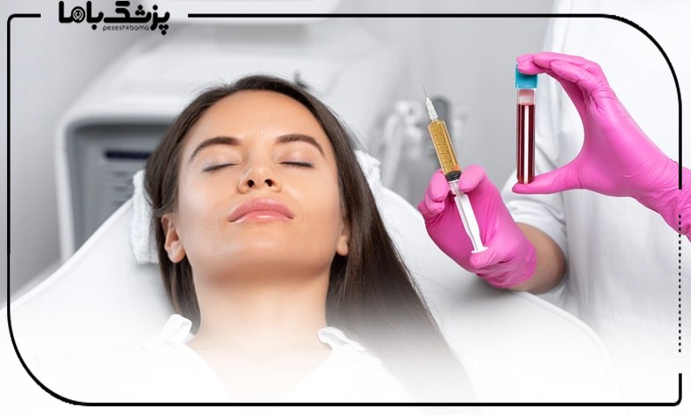 تزریق PRP توسط دکتر پی آر پی ساری