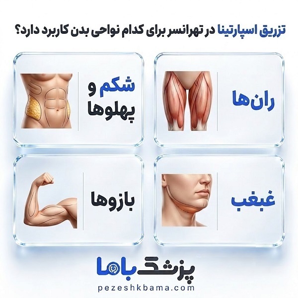 تزریق اسپارتینا در تهرانسر برای کدام نواحی بدن کاربرد دارد؟