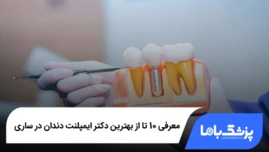 بهترین دکتر ایمپلنت دندان در ساری