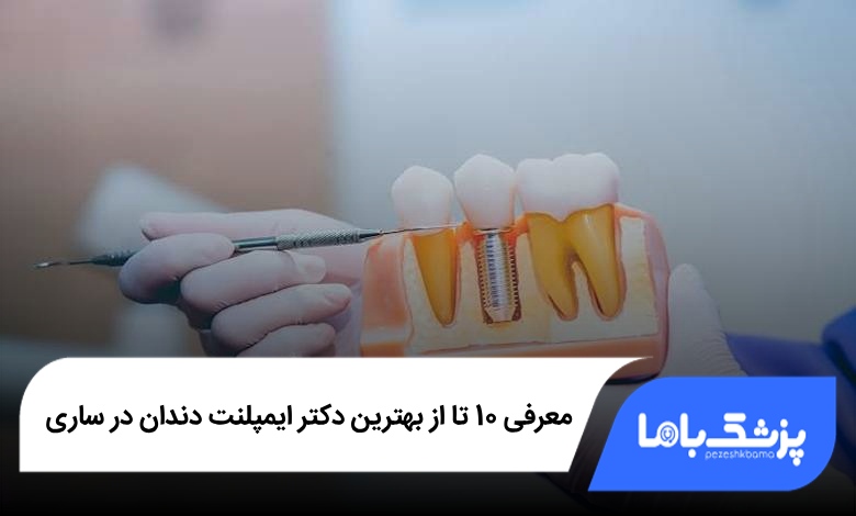 بهترین دکتر ایمپلنت دندان در ساری