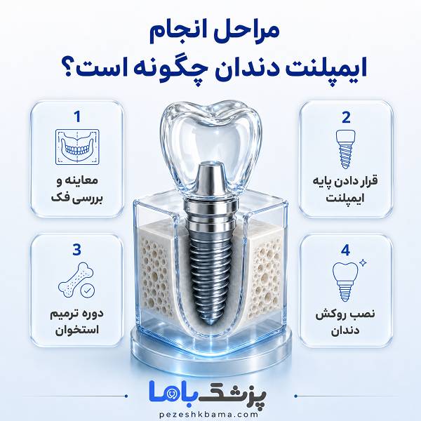 مراحل انجام ایمپلنت دندان چگونه است؟
