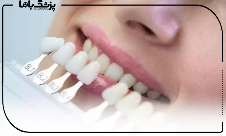 لبخندی ماندگار با لمینت سرامیکی در ساری