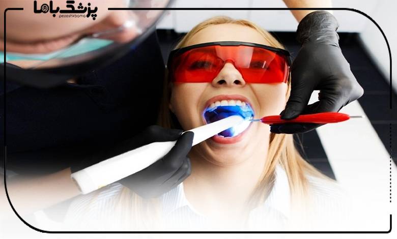 انجام کامپوزیت توسط دکتر کامپوزیت دندان ساری