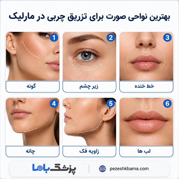 بهترین نواحی صورت برای تزریق چربی در مارلیک