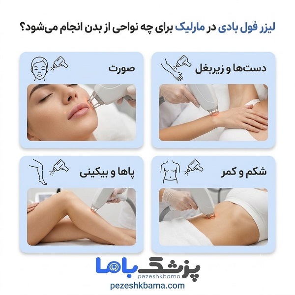 لیزر فول بادی در مارلیک برای چه نواحی انجام میشود؟