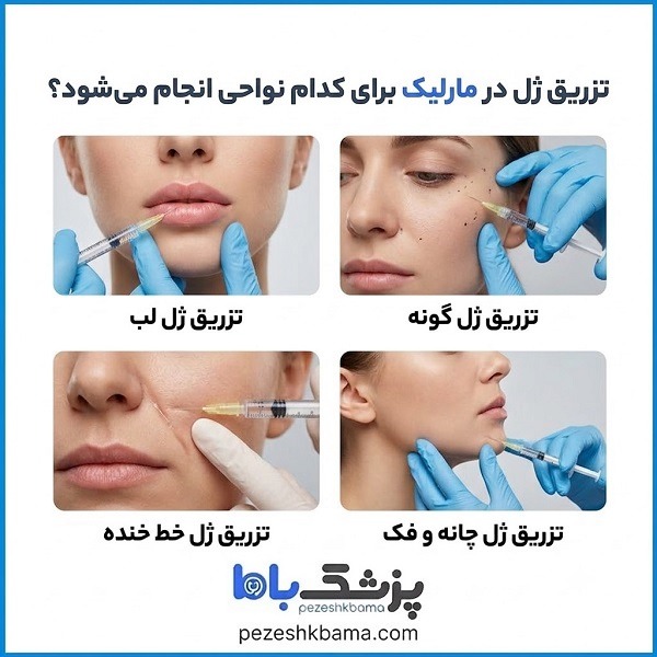 تزریق ژل در مارلیک برای کدام نواحی انجام میشود؟