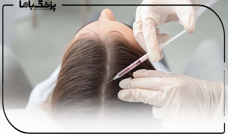 موزتراپی برای درمان ریزش مو در مارلیک