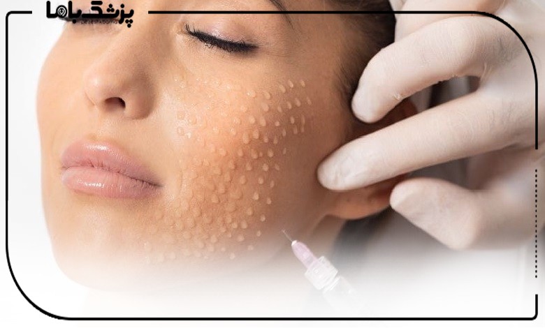 قبل از مزوتراپی چه کارهایی را باید انجام دهیم؟