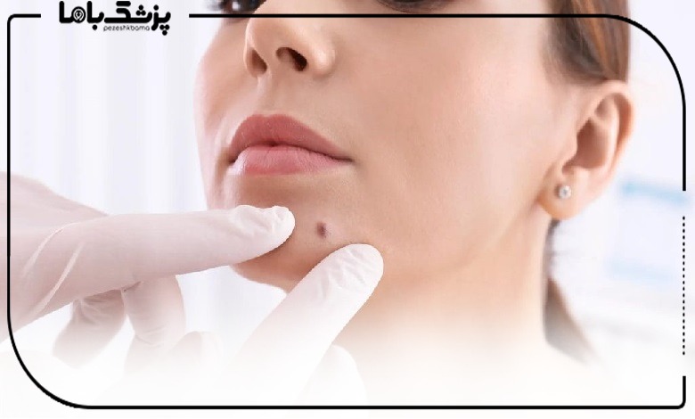 چرا بعضی از خالها بعد از لیزر دوباره برمیگردند؟
