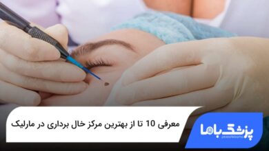 بهترین مرکز خال برداری در مارلیک