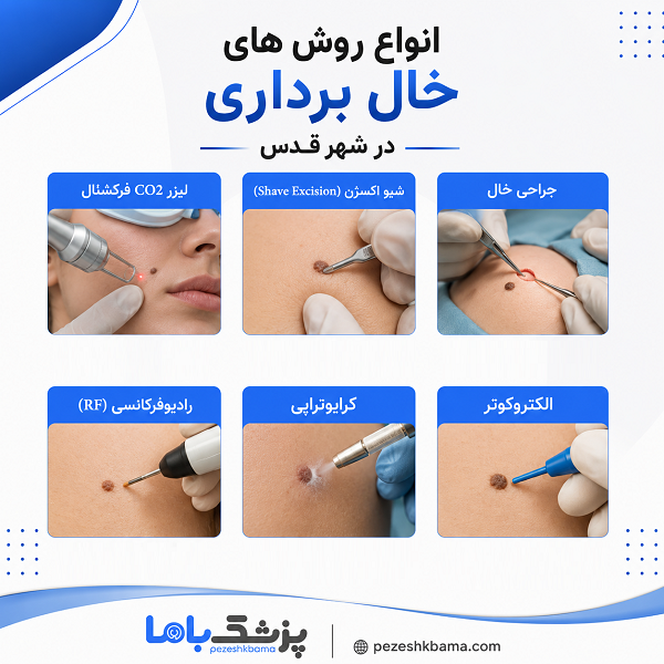 انواع روش های خال برداری در شهر قدس