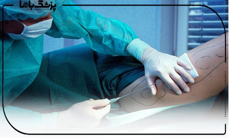 جراحی تخلیه چربی توسط بهترین دکتر لیپوماتیک در اصفهان