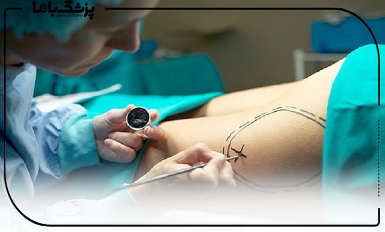 بهترین دکتر پیکرتراشی در اصفهان در حال علامتگذاری ناحیه درمان برای جراحی