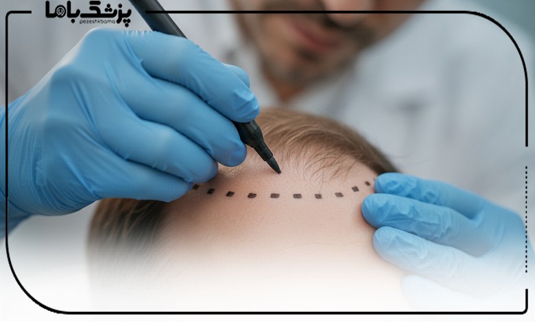 طراحی دقیق خط رویش مو توسط بهترین دکتر کاشت مو در تهران