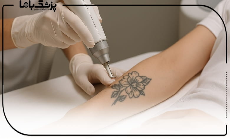تفاوت لیزر کیوسوئیچ و پیکوشور در ریموو تاتو