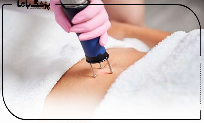 لیزر ترک پوستی در سعادت آباد