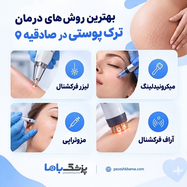 بهترین روش های درمان ترک پوستی در صادقیه