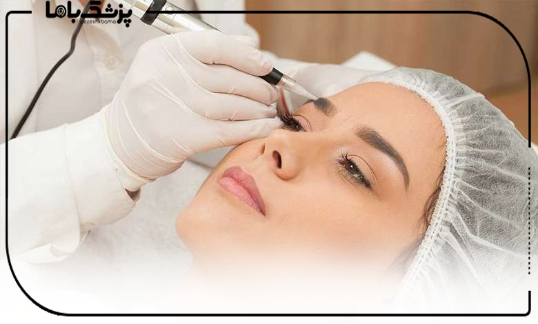 روش FUE کاشت ابرو در کرمانشاه